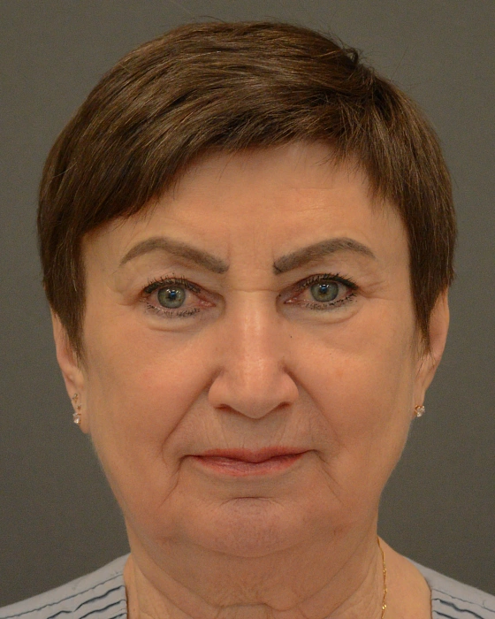 Эндоскопический лифтинг лица